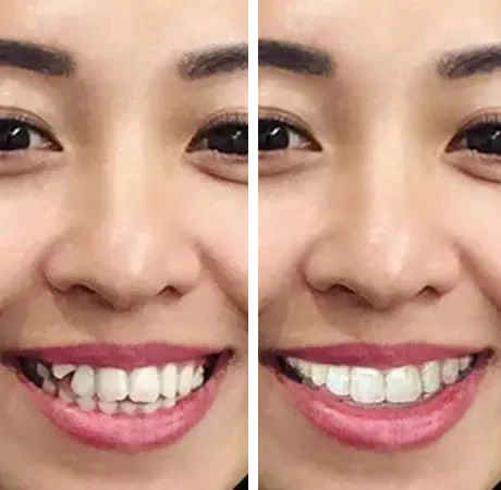 before-after-2