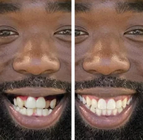 before-after-trans