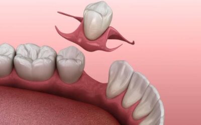 1 Tooth Partial Denture