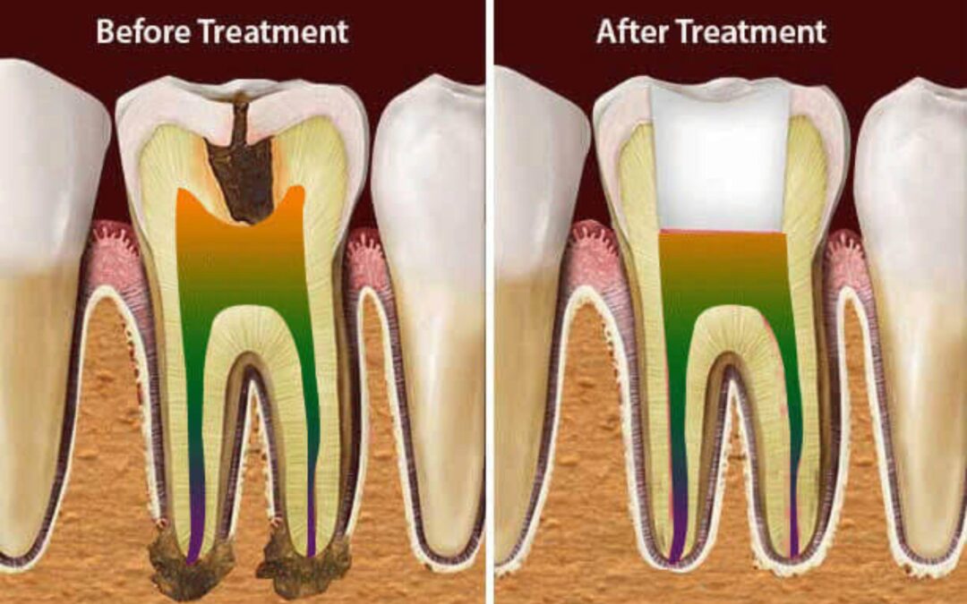 before after root canal