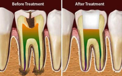 Before after Root Canal