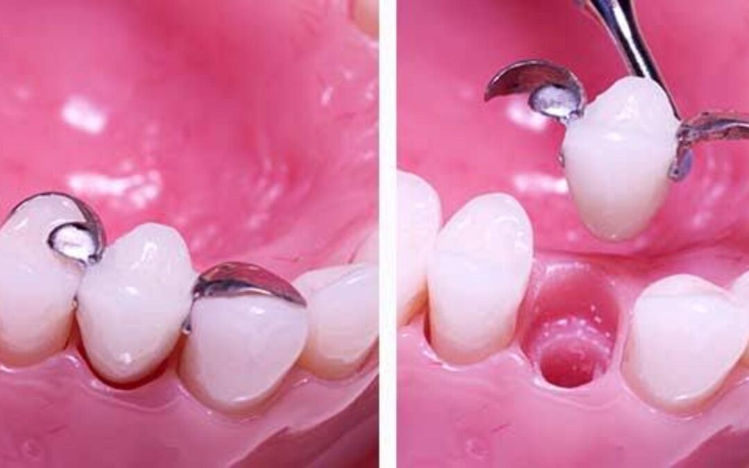 single tooth denture